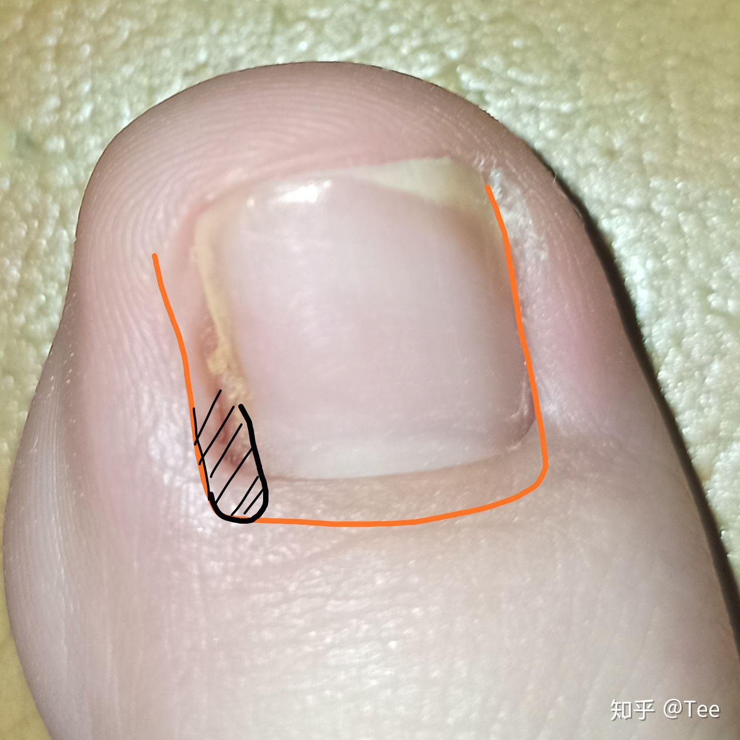 嵌甲,甲沟炎(附图)? - 知乎