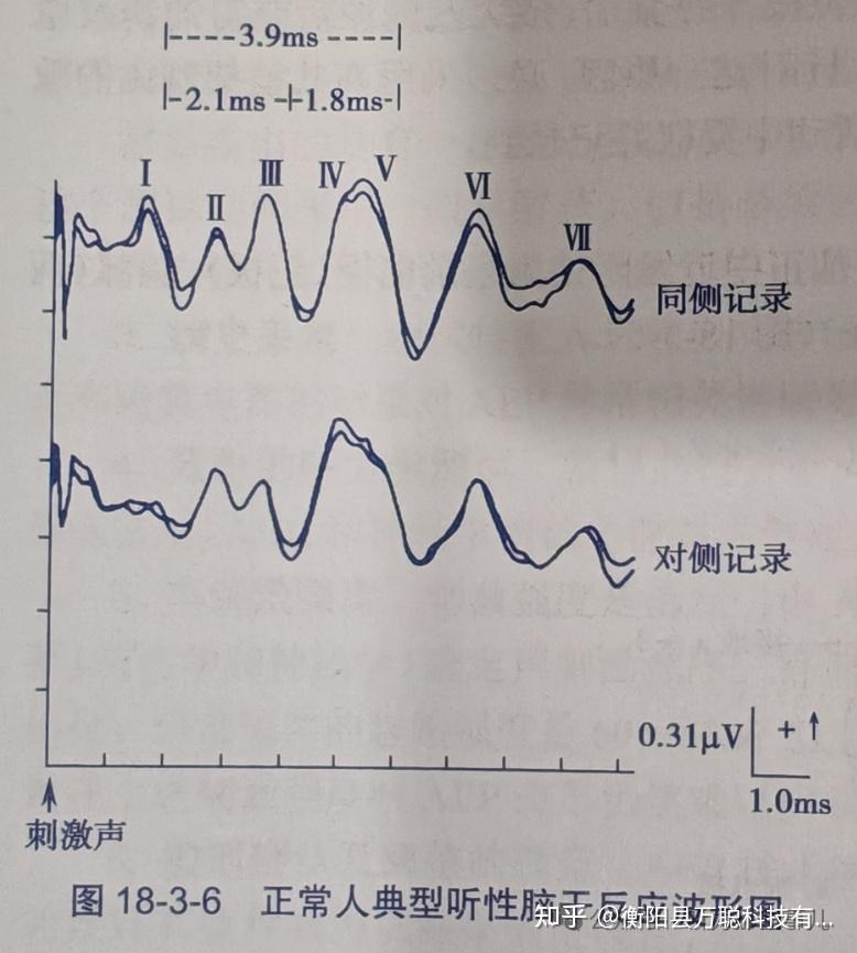 什么是ABR?如何看懂ABR报告? - 知乎