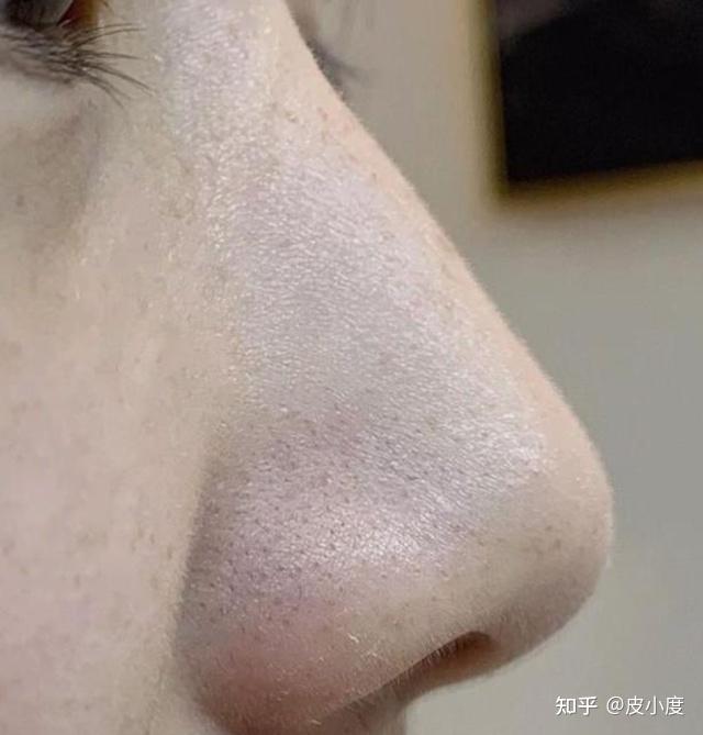 几十块的药膏就能祛痘治黑头？别乱用啦 - 知乎