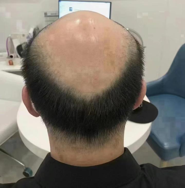 植发后应该做什么？ - 知乎