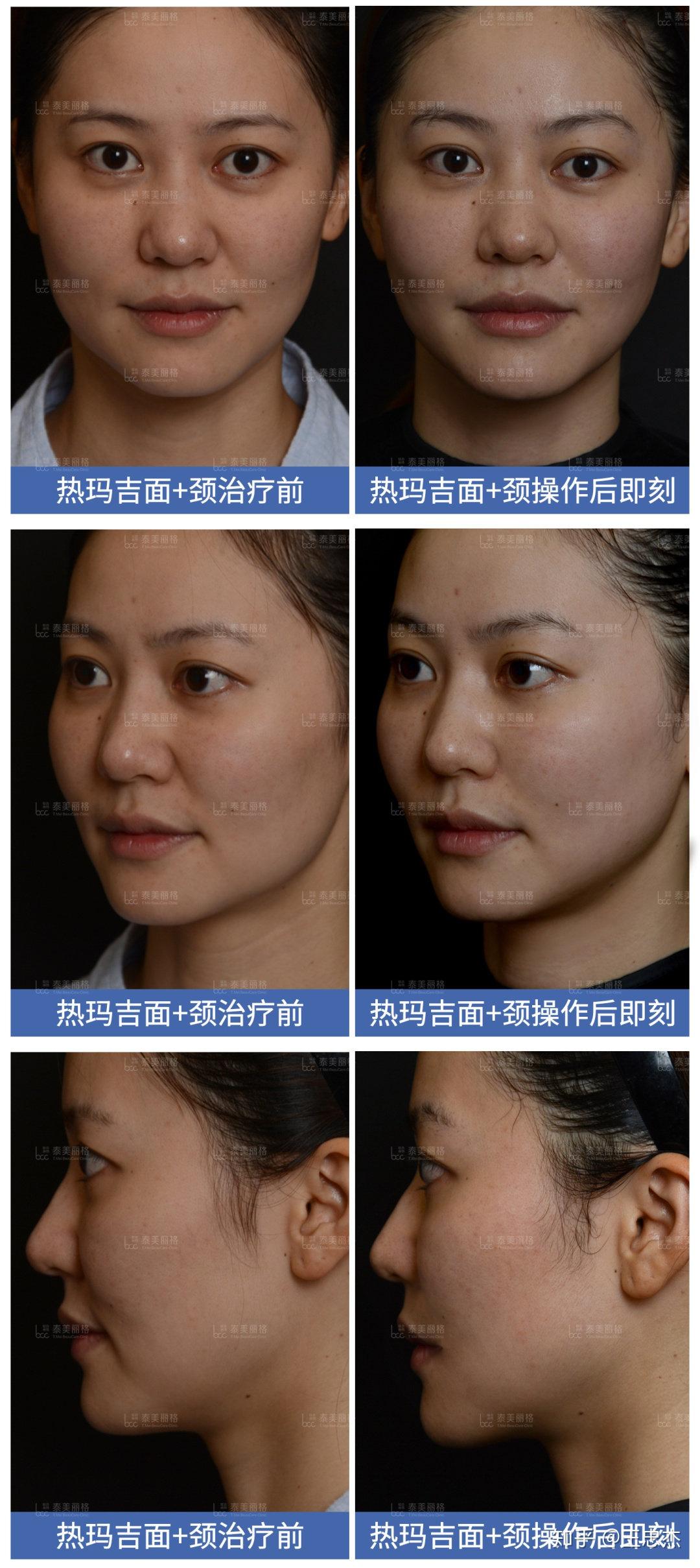 同为抗衰神器,fotona 4d pro和热玛吉,到底该如何选择? - 知乎