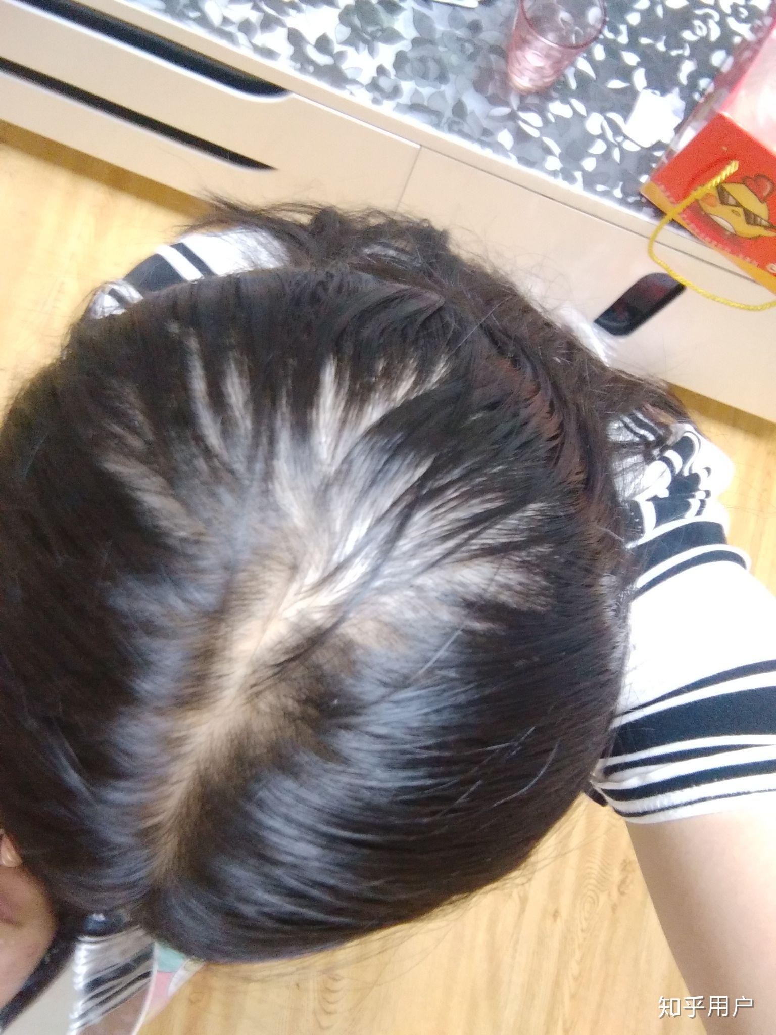 怎么处理后脑勺头发稀少问题