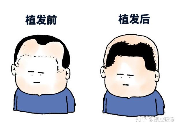 为什么植发机构那么猖獗(植发为什么这么贵而且容易掉)