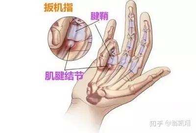 得了腱鞘炎怎么办? - 知乎