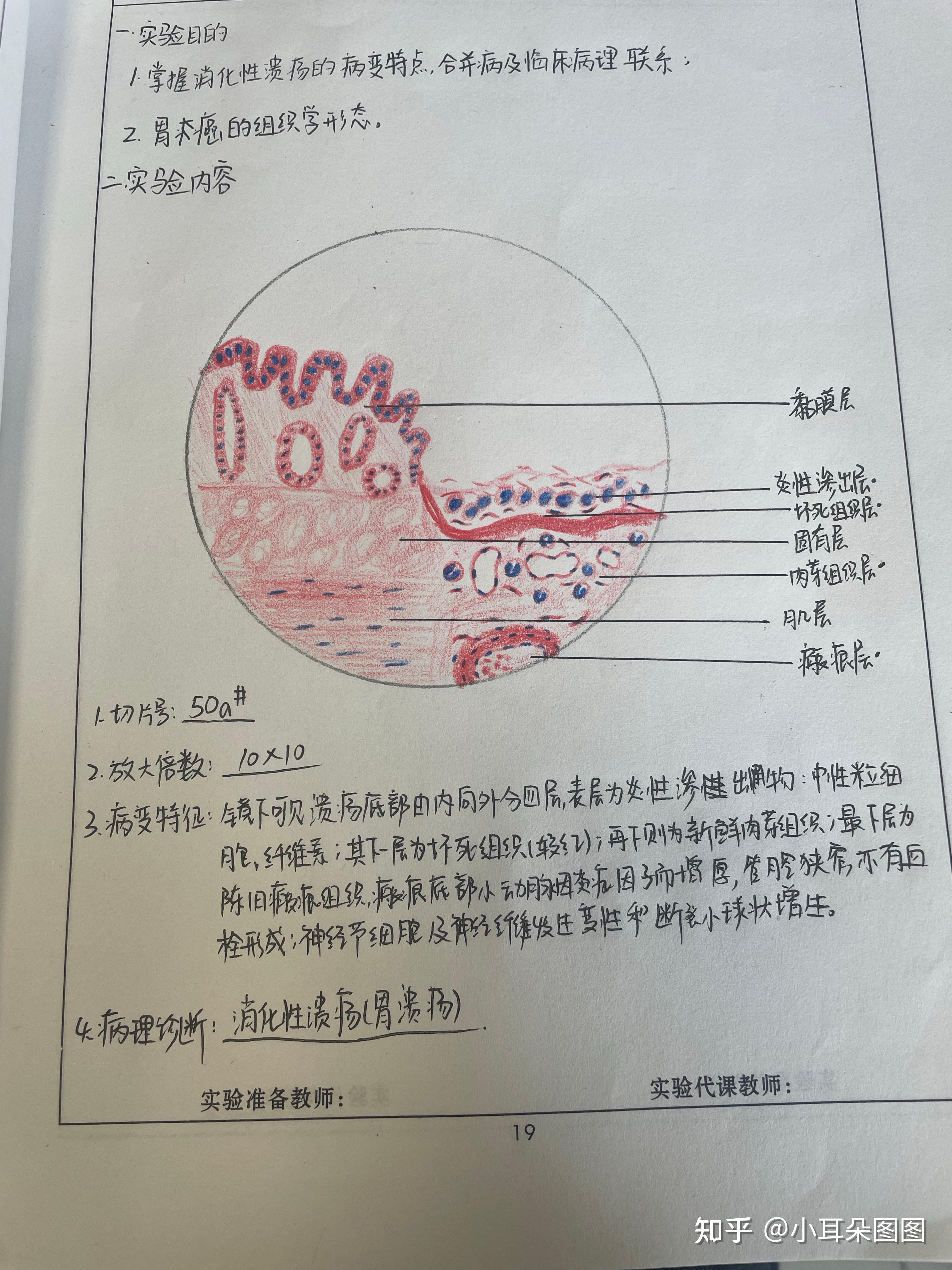 慢性胃溃疡手绘图图片