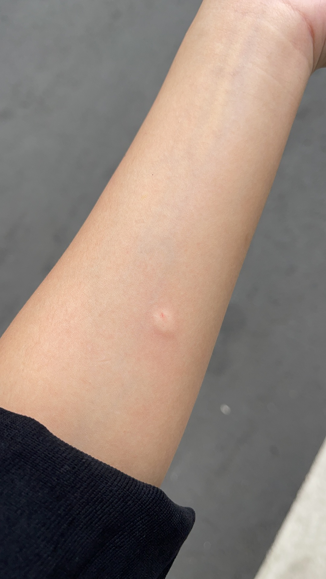 结核皮试起了个大水泡,破了怎么办? - 知乎