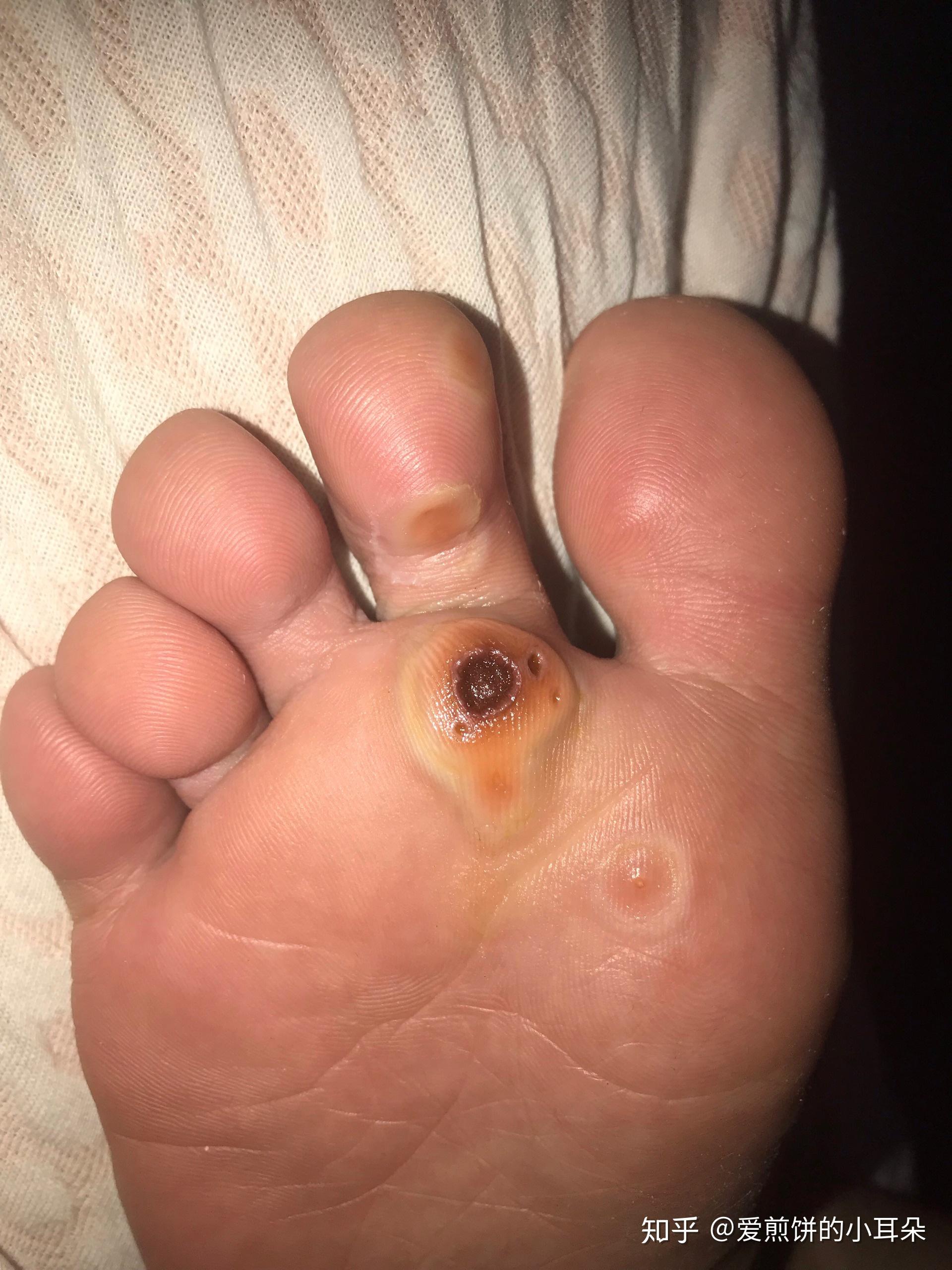 第七天  走路已经瘸了六天了第六天  泡完脚的样子第五天  今天不碰就