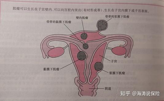 常常在子宫壁上(子宫壁分为三层):子宫肌瘤是子宫壁上由肌肉组织和