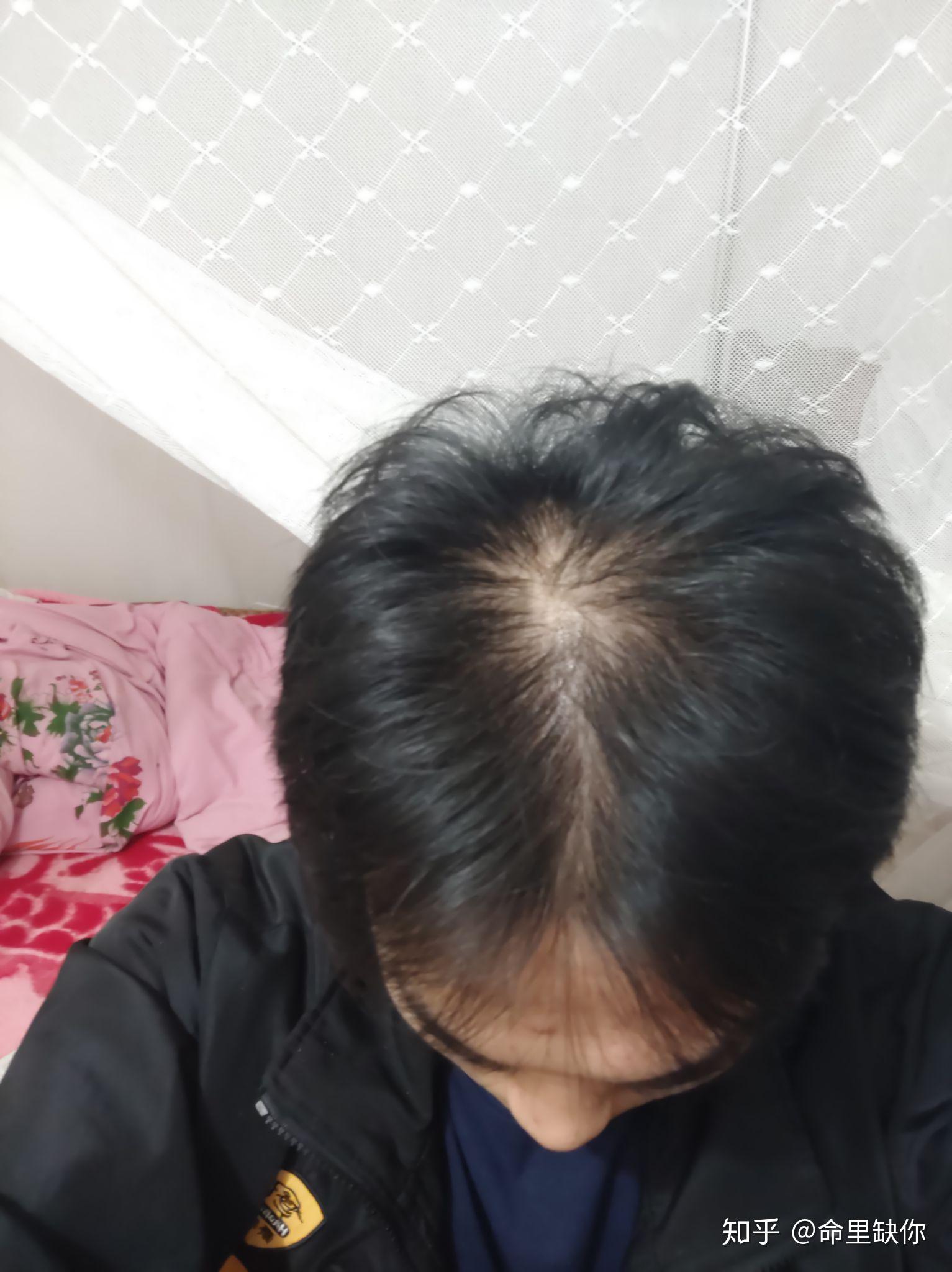 我的头上的头发很少 我今年十八岁,平时头上较多油.