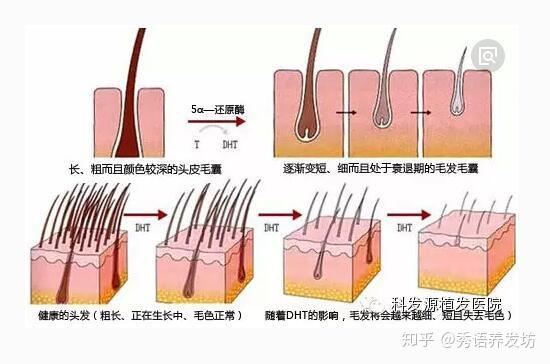 只要毛囊健康,無論頭髮怎麼掉,掉多少次,毛囊也會再次合成頭髮.