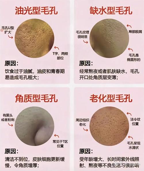 不止毛孔粗大,还满脸油光怎么办?小美解救毛孔全对策 - 知乎