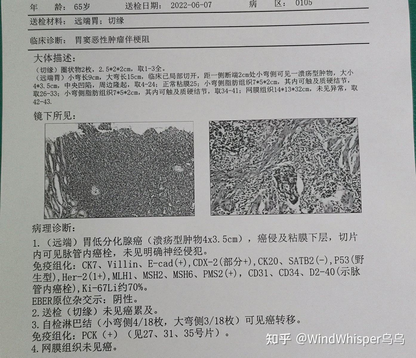 腺癌 实验报告图片