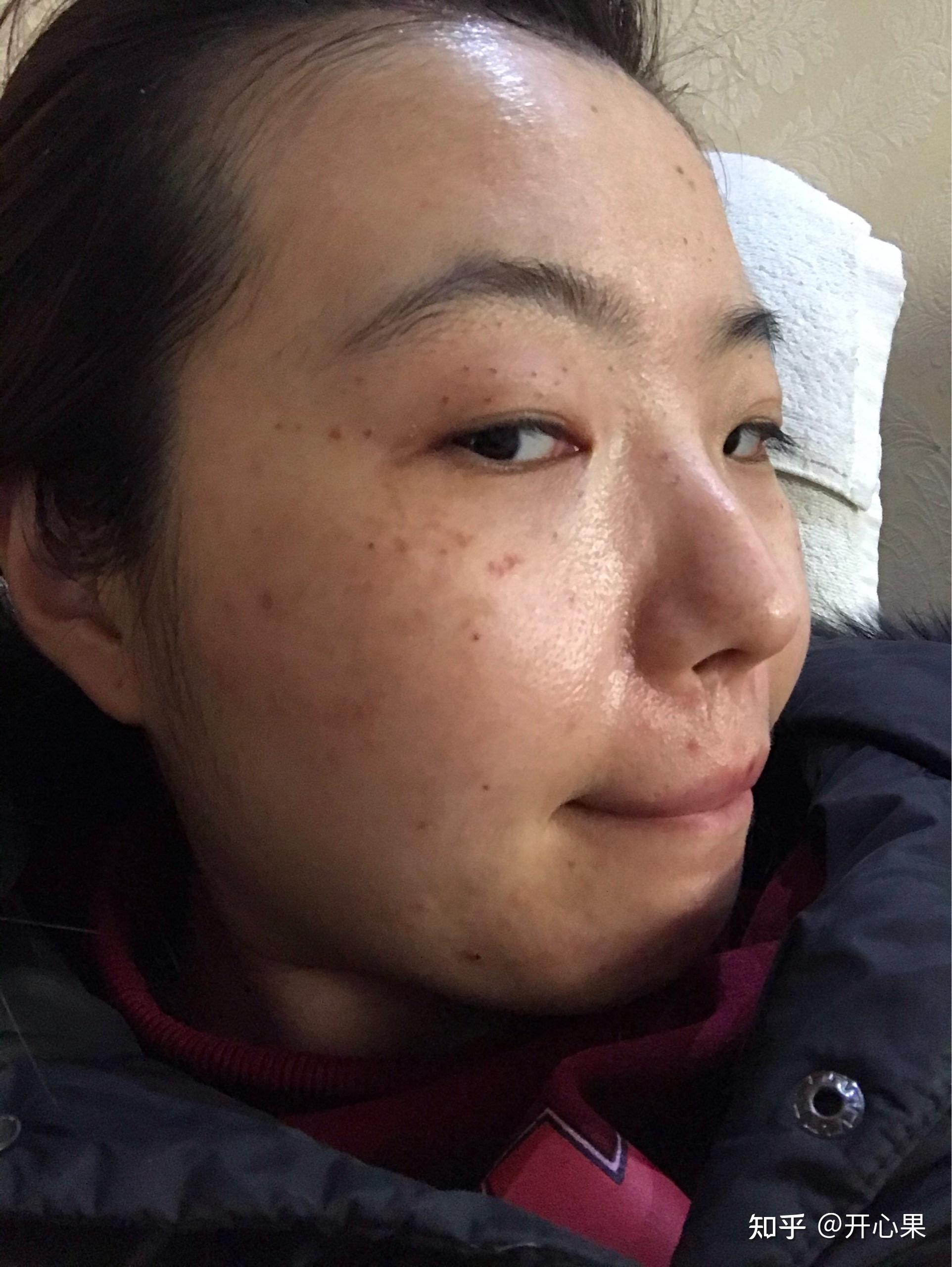 超皮秒祛斑效果