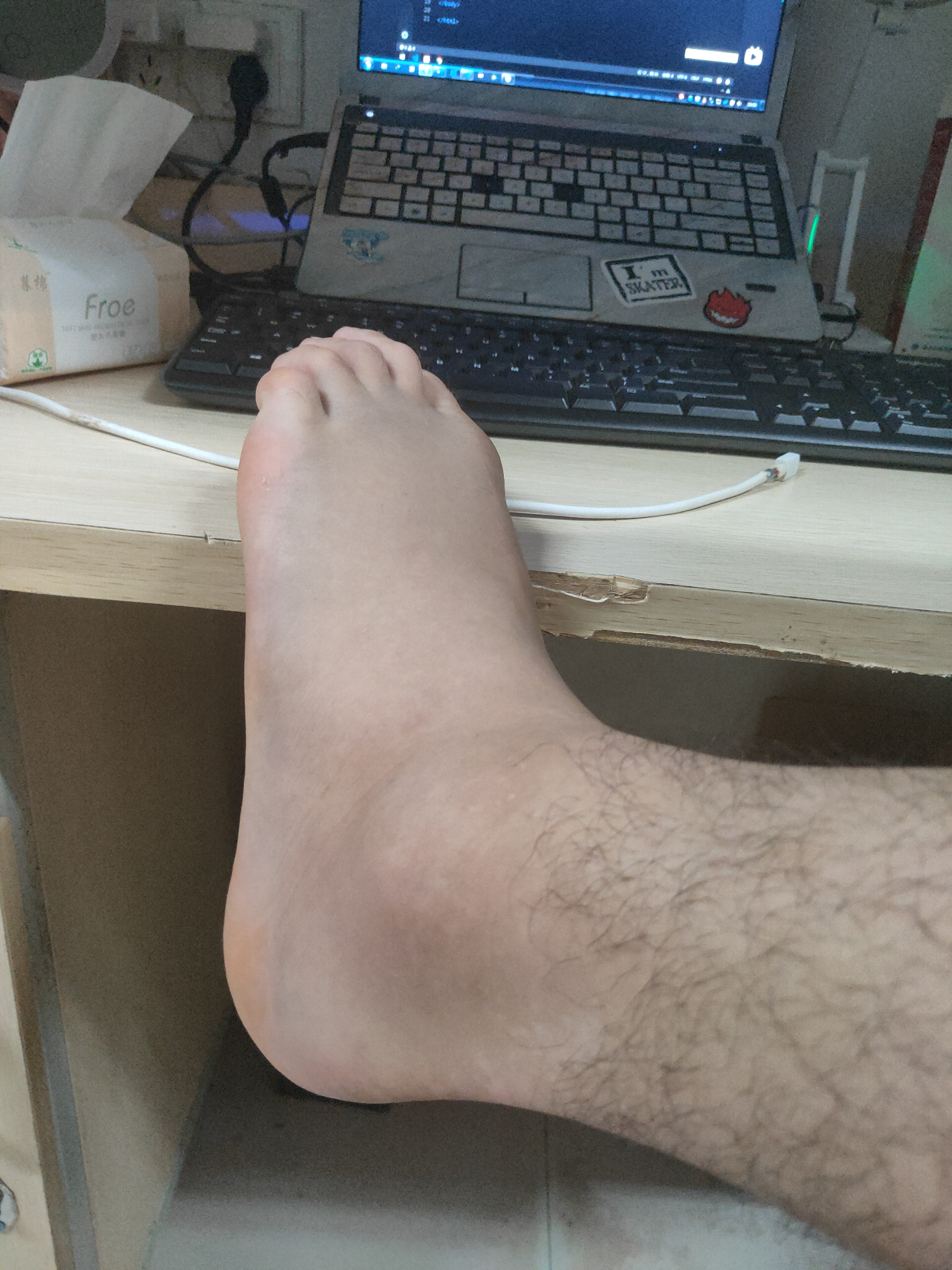 你滑滑板时崴了脚是怎样的体验