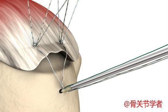 铆钉固定缝合撕裂的肩袖伤口3-5个一厘米大小伤口最后教大家一个简单
