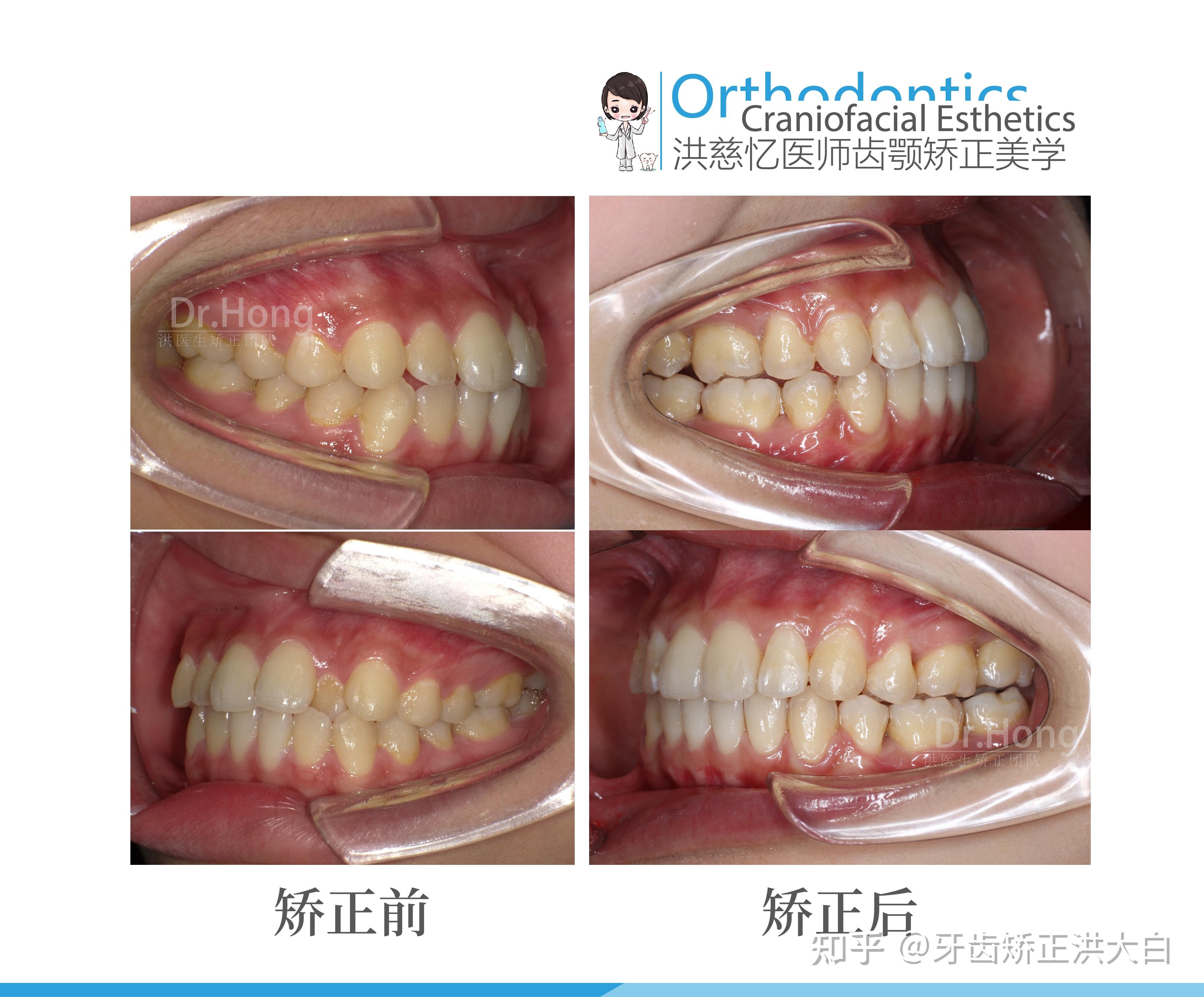 牙齿矫正后侧面变化有多大? - 知乎