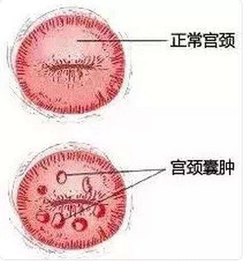 宫颈囊肿是什么