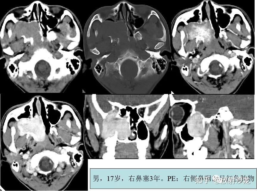 6种鼻咽部疾病的影像诊断与鉴别 - 知乎