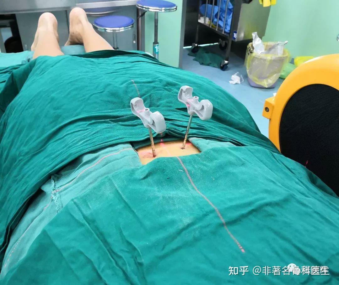 高龄腰椎骨质疏松性骨折pvp(骨水泥注射成型术) - 知乎