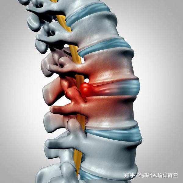 怎样治疗腰椎肩盘突出_腰椎间盘突出论坛_中央台腰椎肩盘突出治疗仪