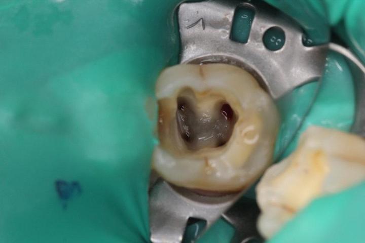 仙游牙科根管治疗的基本步骤有哪些