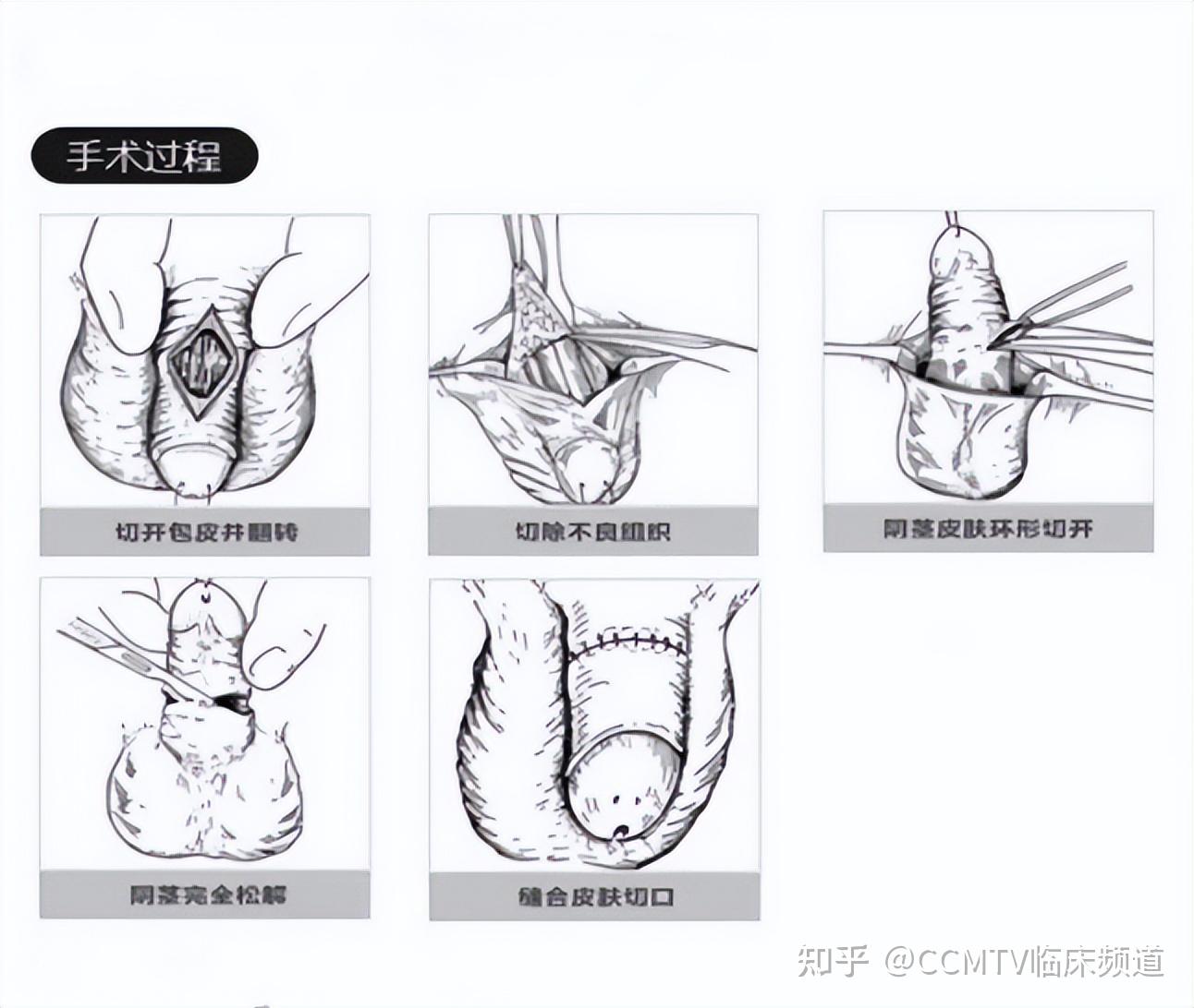 包茎扩张术 分离术图片