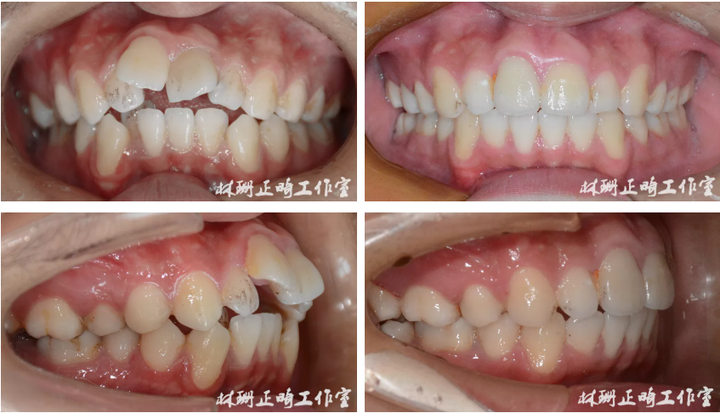 福州牙齒矯正案例 | 前突齙牙患者害怕骨釘,改用z鉤依舊獲得非常好的