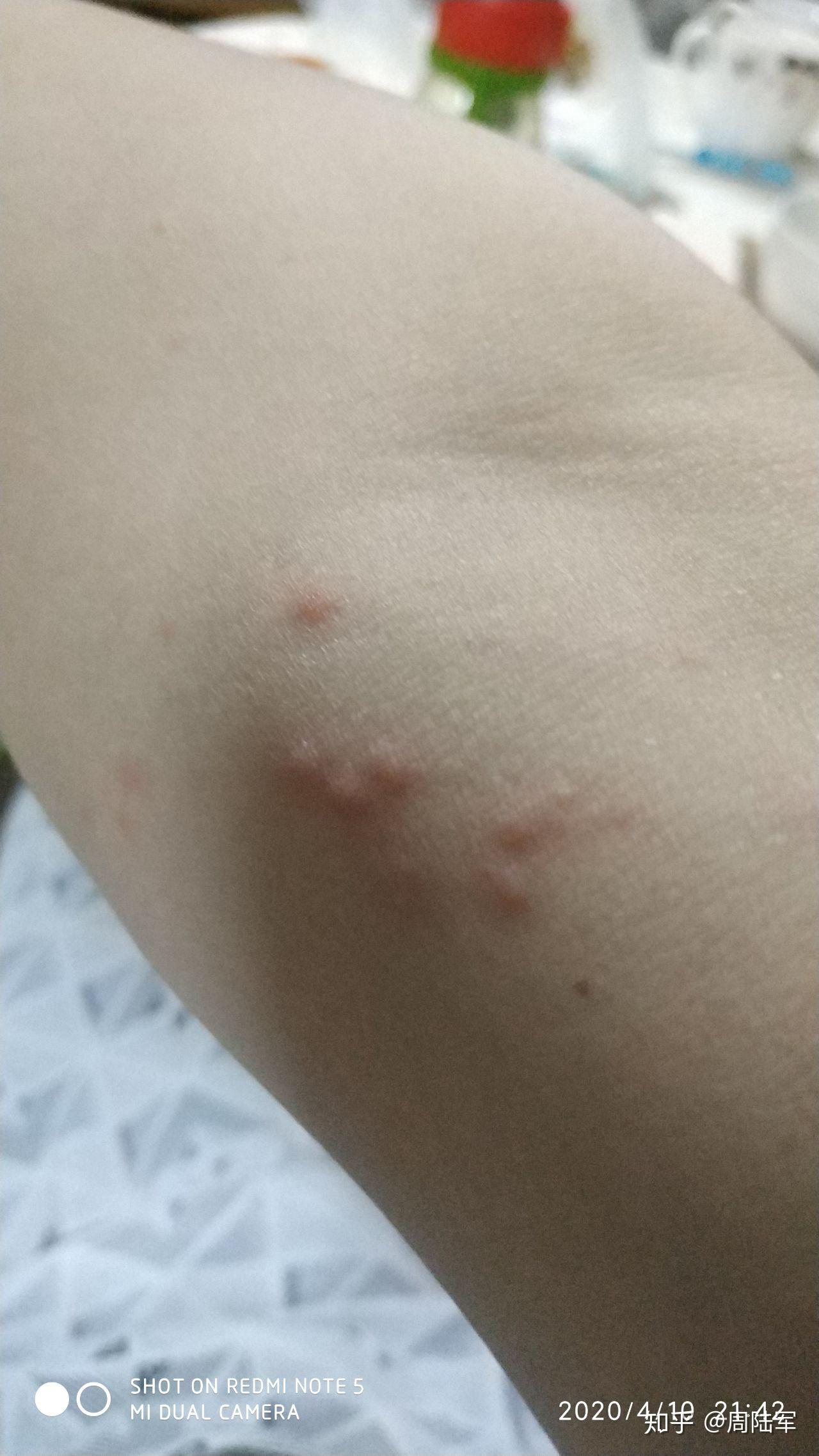 带状疱疹的诱因是什么如何有效治疗