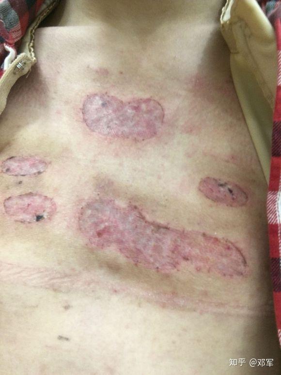 抗瘢日记丨胸口大片瘢痕疙瘩手术植皮浅放持续更新