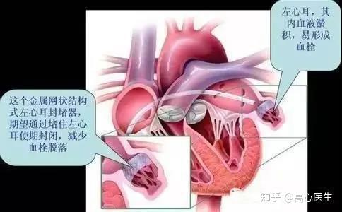 給心臟加道門阻斷房顫患者腦卒中的源頭