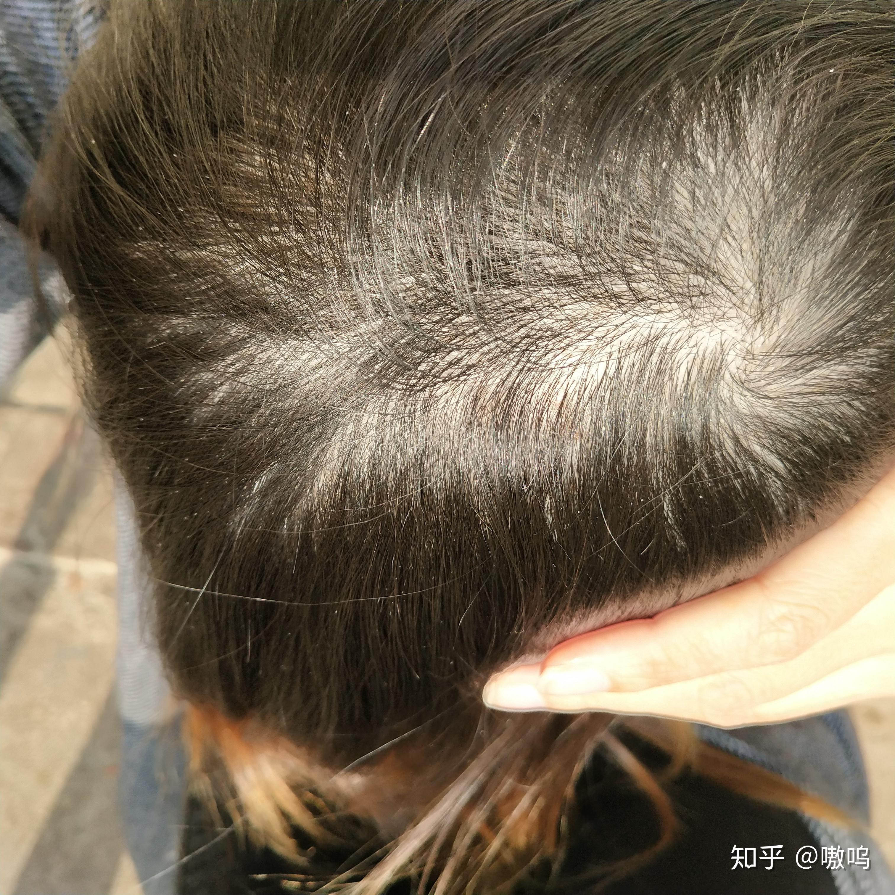 女生头顶头发少是什么体验