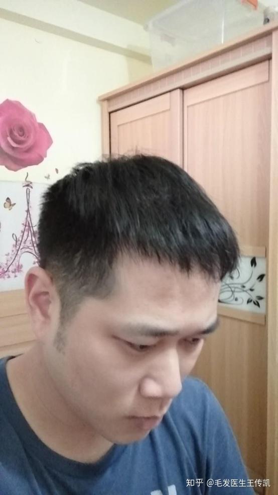 在广州雍禾植发了一年多终于摆脱秃顶的标签了