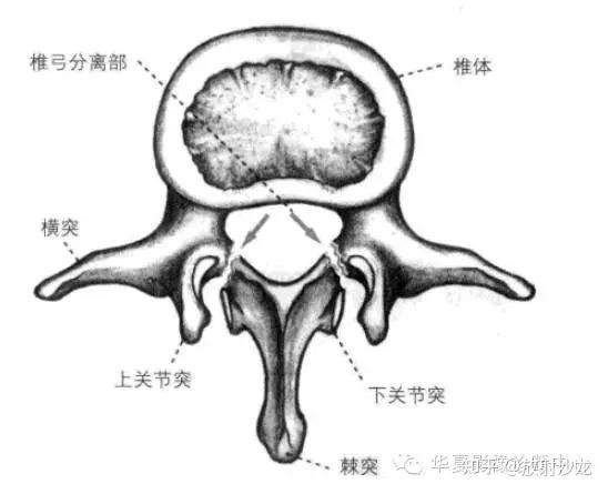 基础解剖图实实在在明白腰椎椎弓峡部裂与椎体滑脱