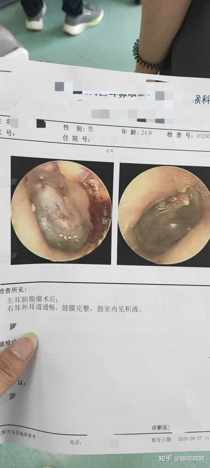 做过外耳道胆脂瘤或中耳胆脂瘤手术的人现在都怎么样了