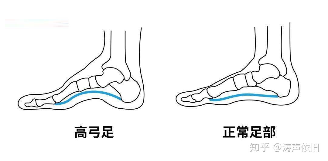 足弓判断图片