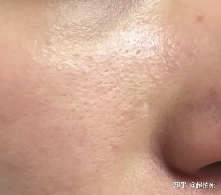 毛孔粗大痘痘黑头多大油脸怎么办4步解决皮肤问题3个月养成细腻肌肤