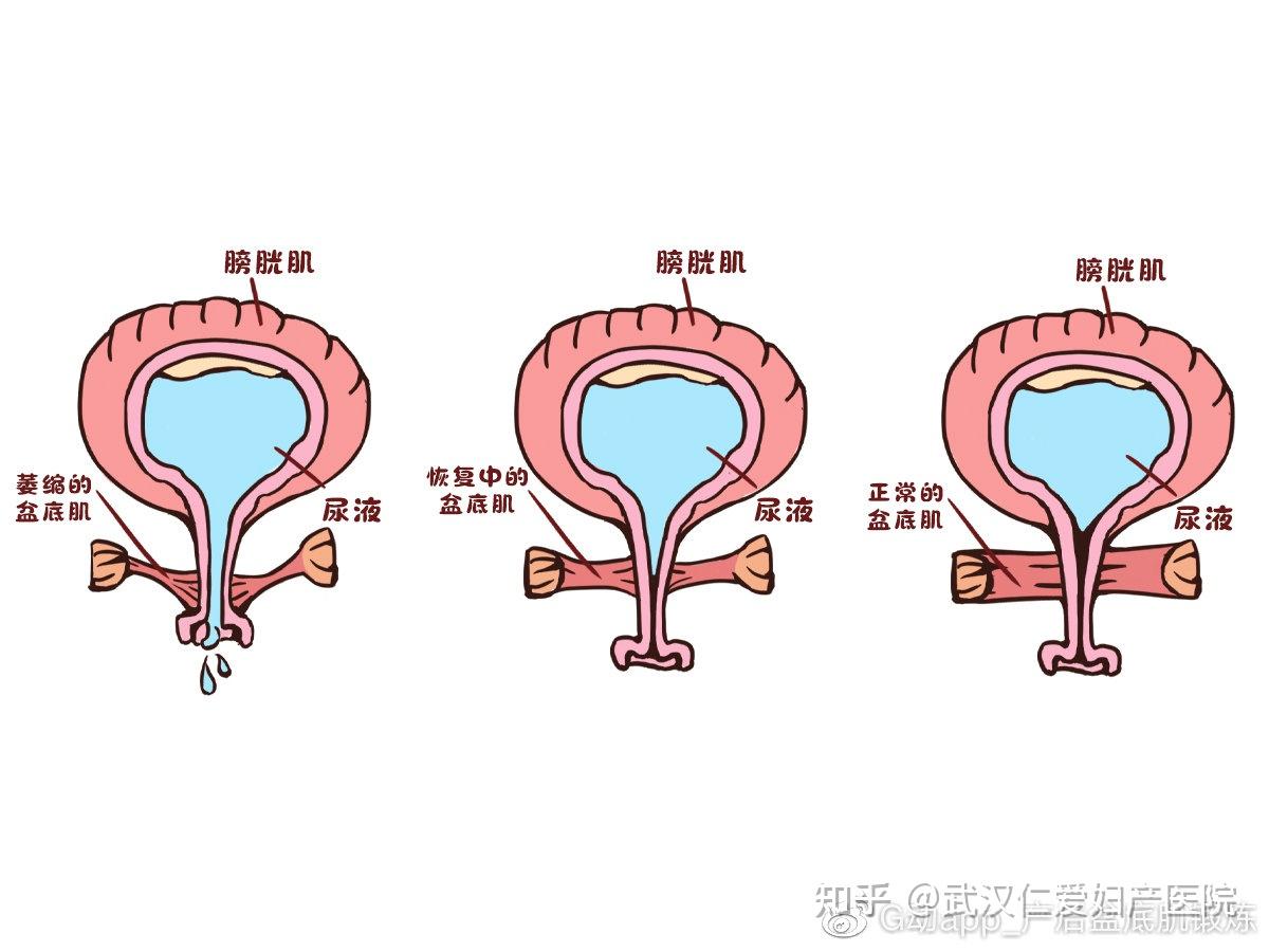 治漏尿的小窍门 知乎