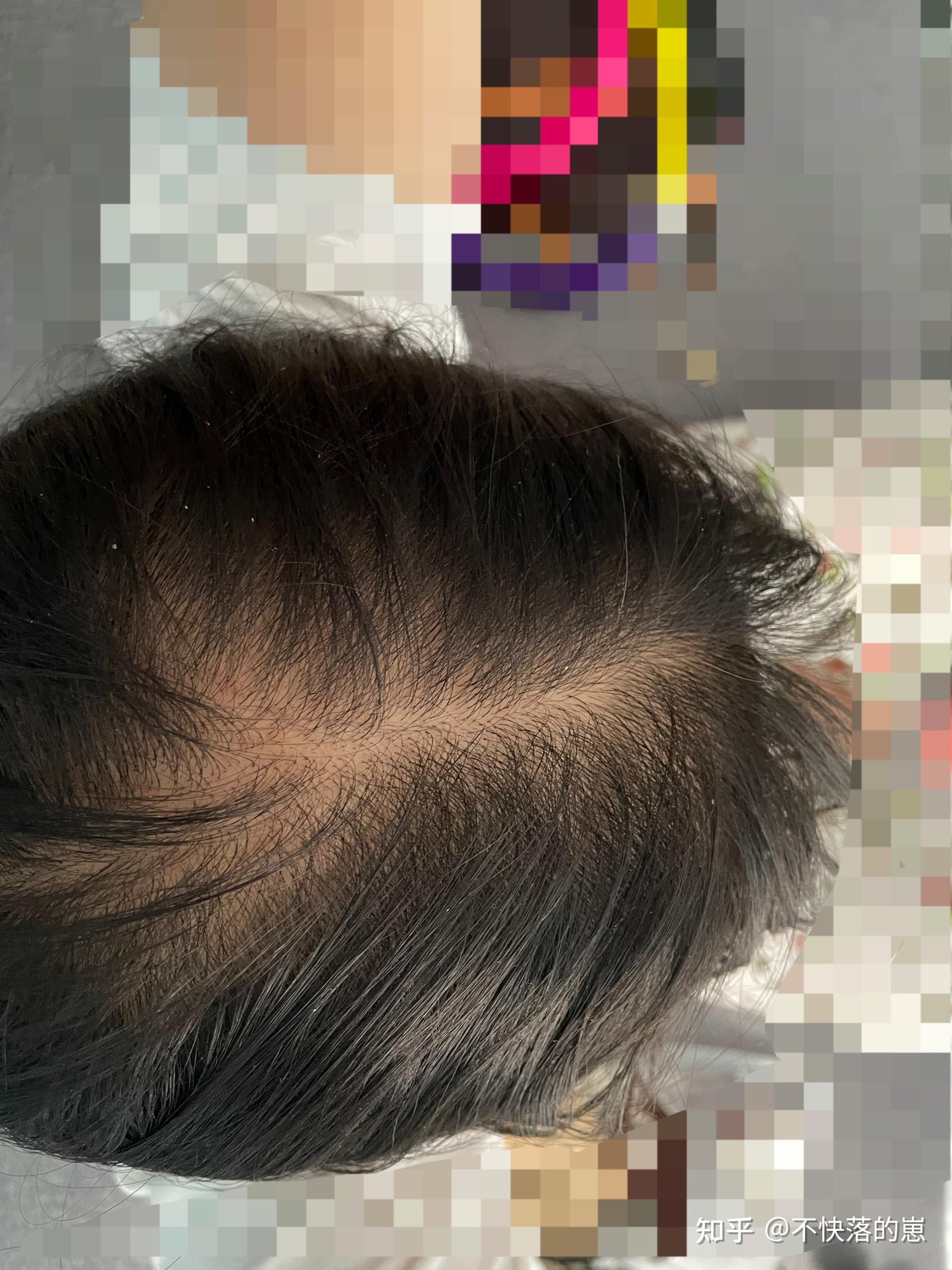 女性雄激素性脱发 - 知乎