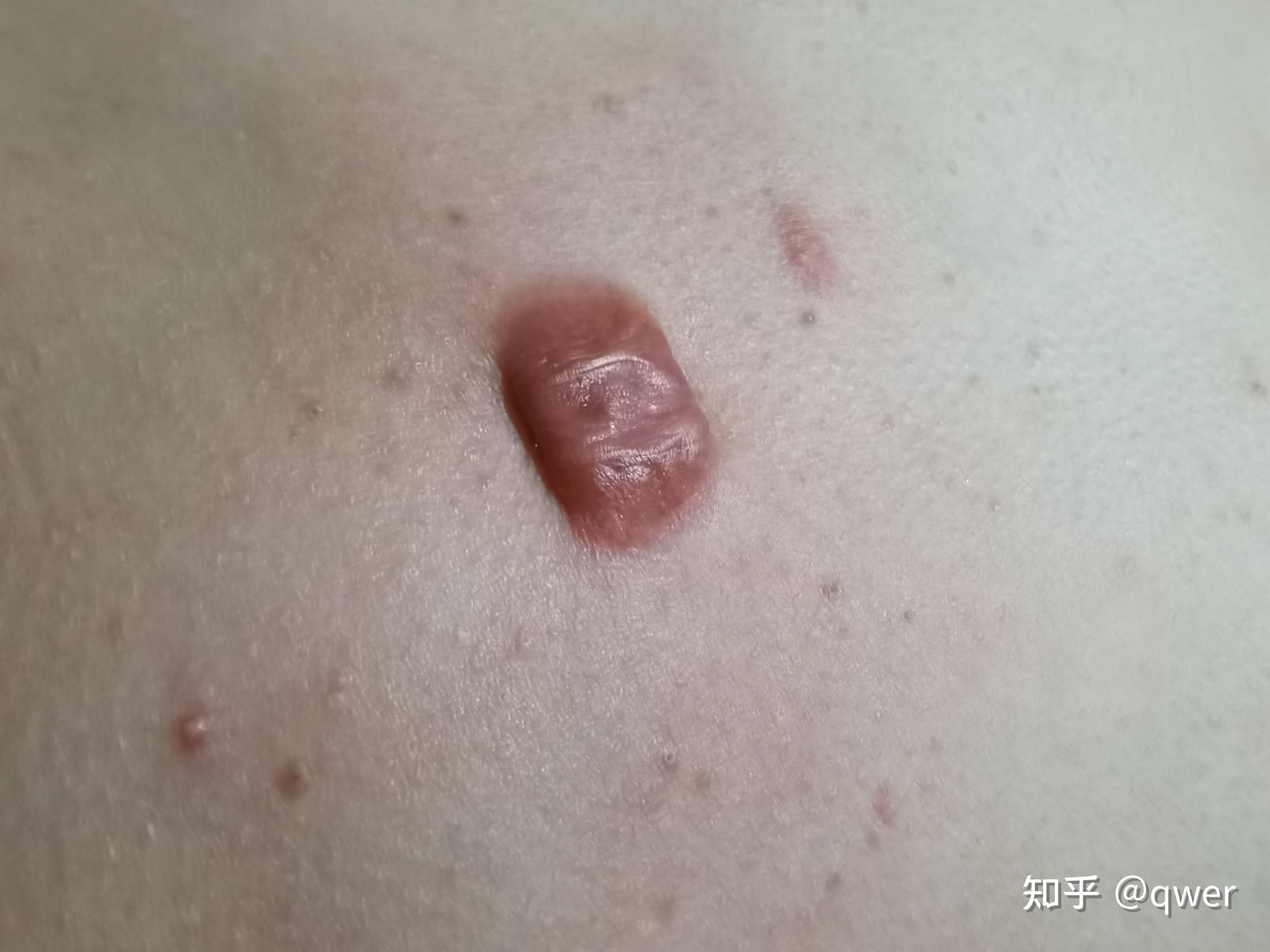 成都瘢痕疙瘩治疗