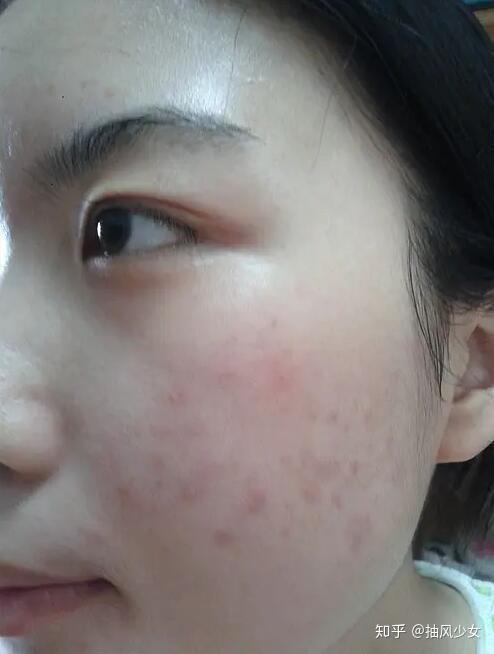 一年左右的红色的痘印怎么去除
