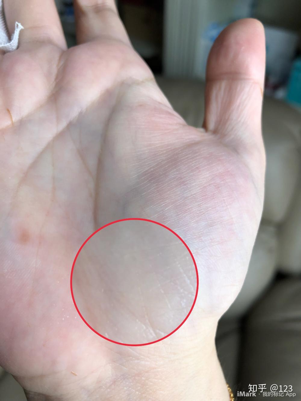 求助 皮肤问题 有人手掌皮下长过透明颗粒吗?