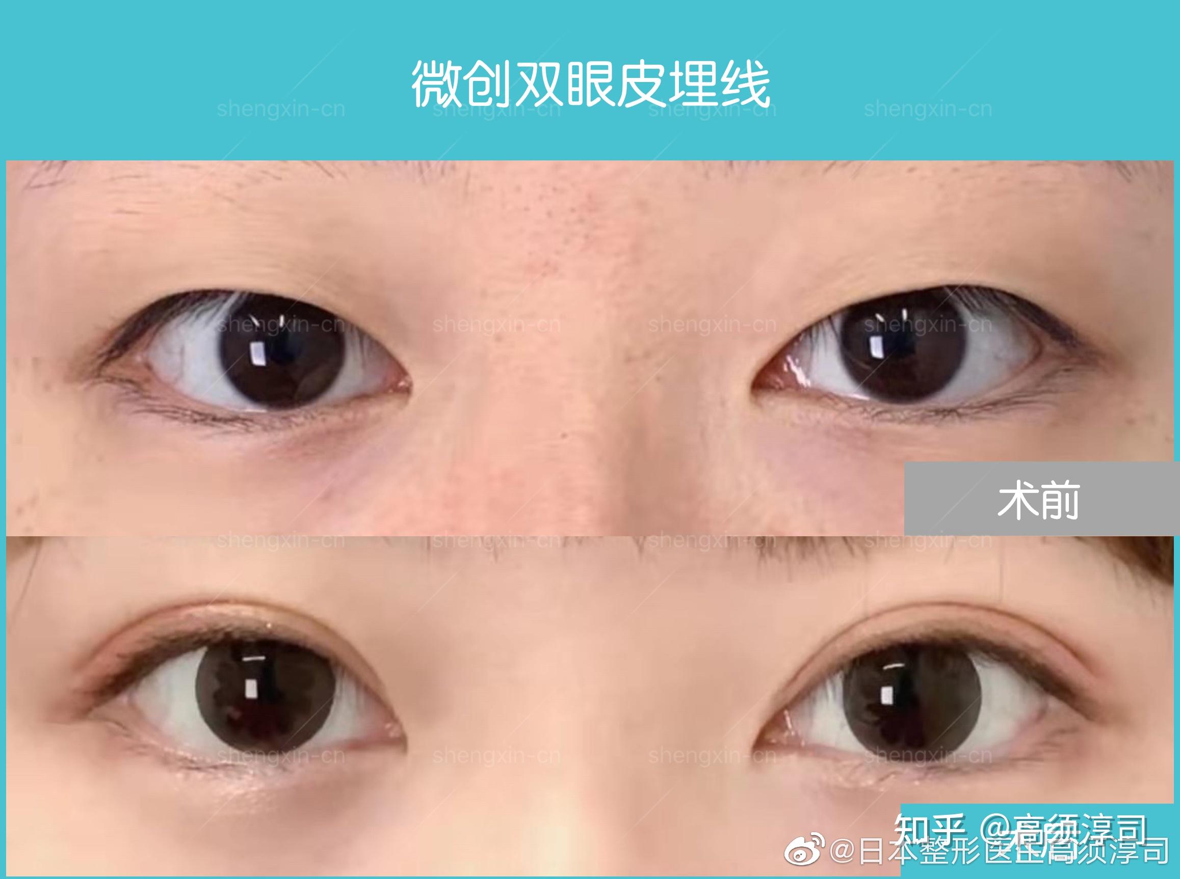 双眼皮埋线法的原理是什么? - 知乎