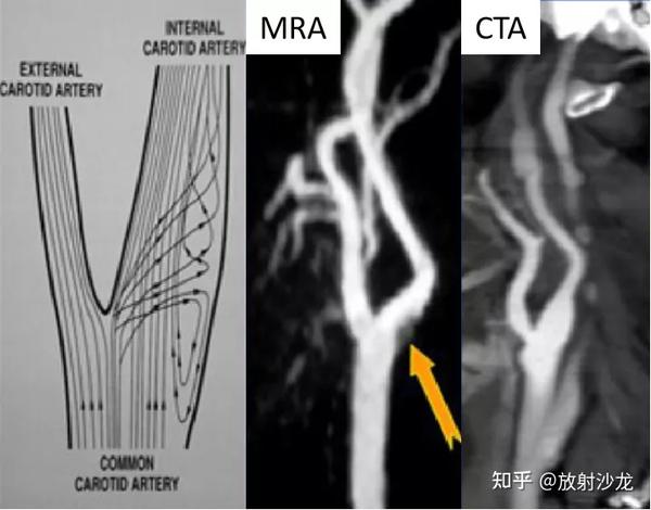 头颈部CTA 与MRA 有什么异同点，它们各自有何局限性？ - 知乎