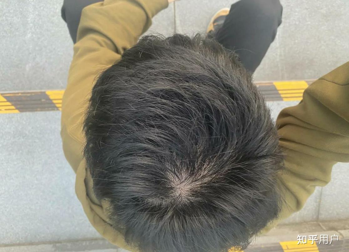 男,32岁,脱发6年,头顶已经很稀疏,有什么办法吗? - 知乎