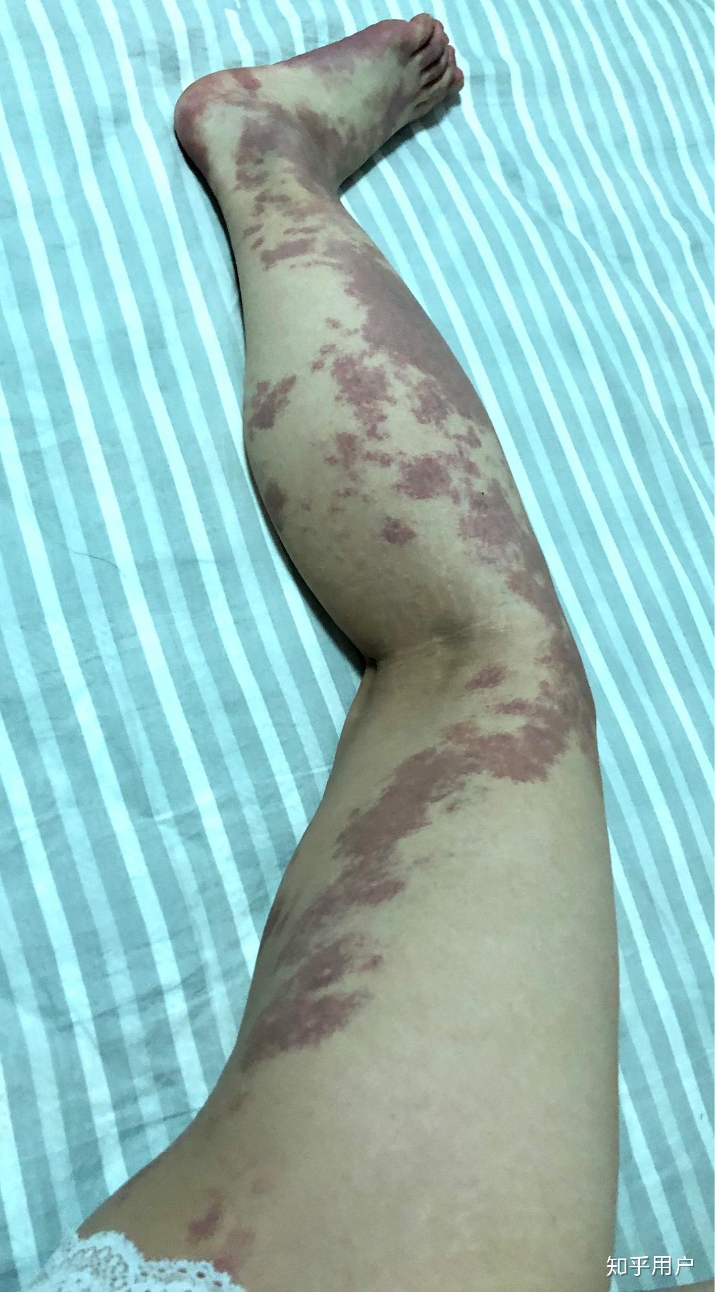 有大面积的胎记是什么体验?