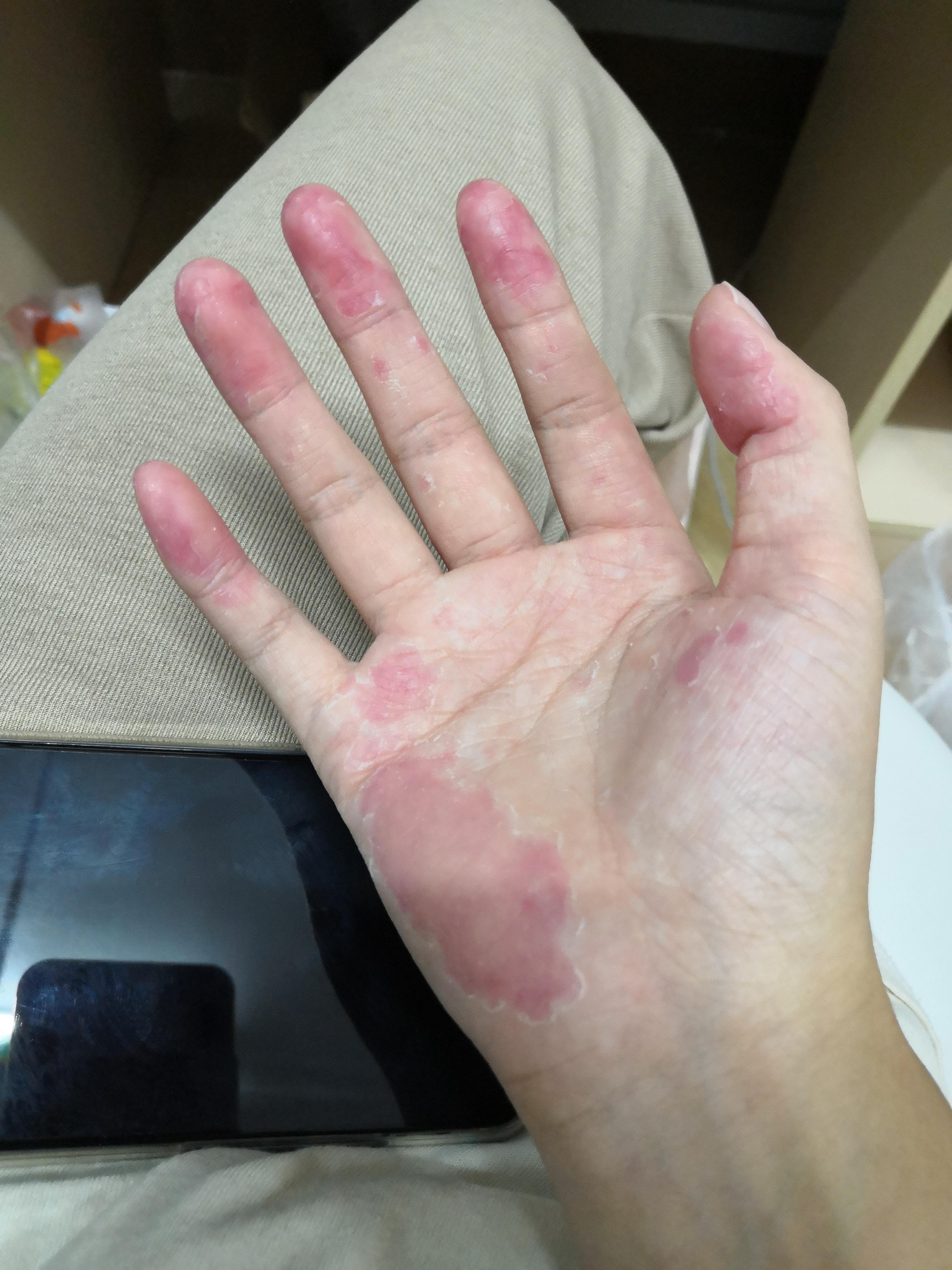 为什么手指头经常脱皮变硬?