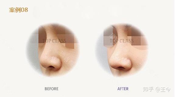 男性隆鼻 一 男性隆鼻与女性隆鼻区别 知乎