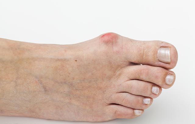 张树伟科普为什么要治疗拇外翻