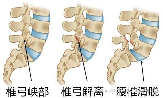 腰椎第四第五节位置图片