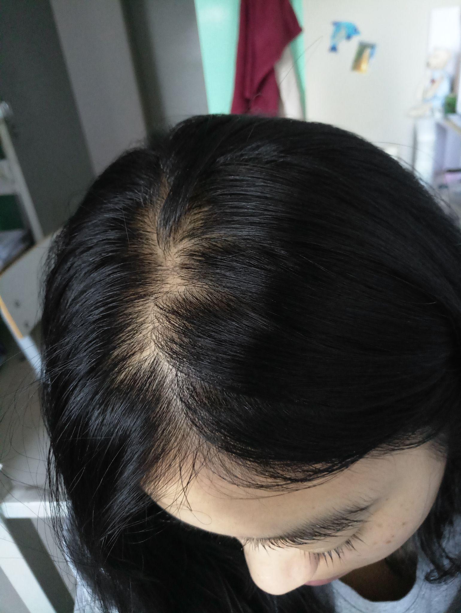 这样脱发还有救吗 头发稀疏露头皮?